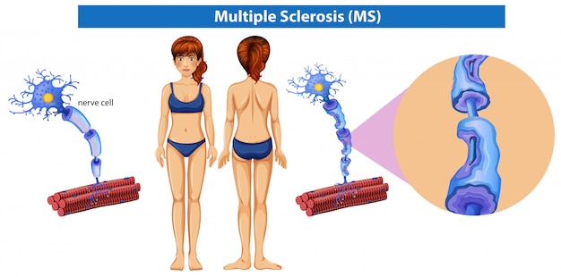 Vecteur gratuit anatomie humaine de la sclérose en plaques