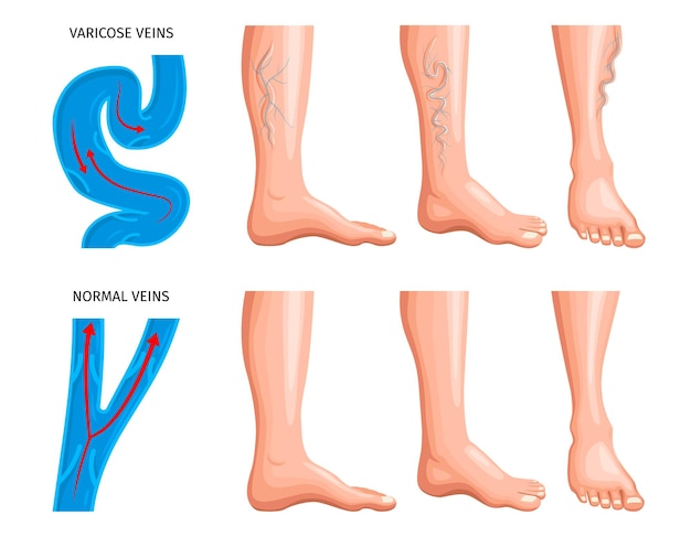 Vecteur gratuit anatomie des varices réaliste avec schéma grossissant des vaisseaux sanguins dans l'illustration vectorielle des veines saines et endommagées