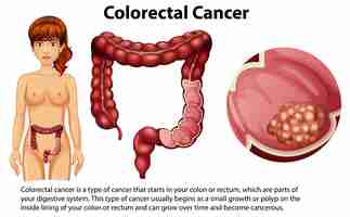 Vecteur gratuit cancer colorectal avec explication