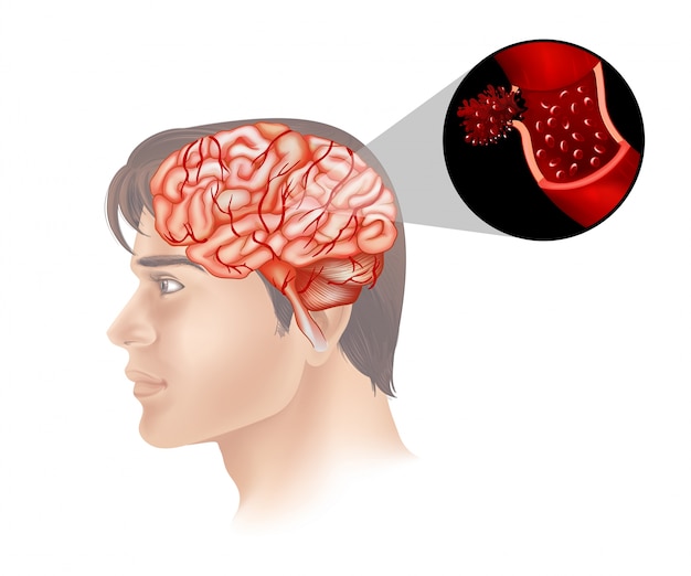 Vecteur gratuit le cancer du cerveau chez l'homme