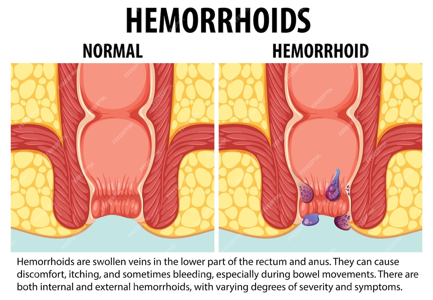 Comparaison Des Hémorroïdes Normales Et Internes Une Infographie éducative Vecteur Gratuite