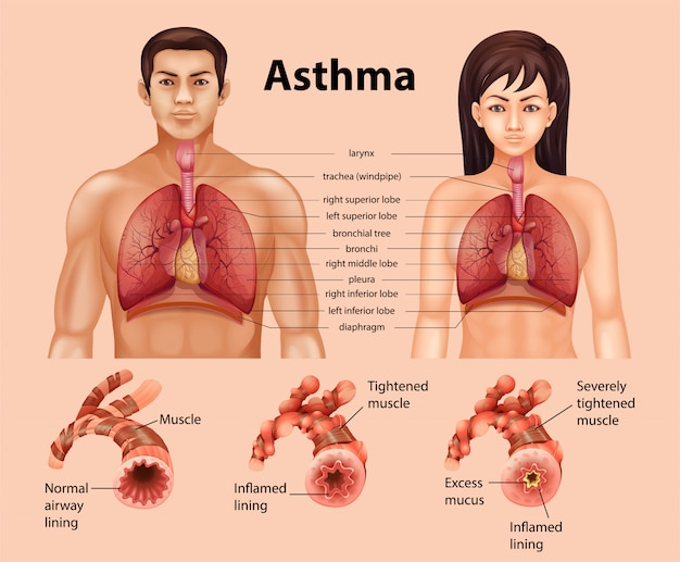 Vecteur gratuit comparaison d'un poumon sain et d'un poumon asthmatique