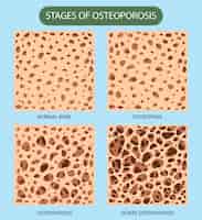 Vecteur gratuit densité osseuse et vecteur d'ostéoporose
