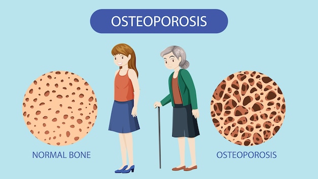 Vecteur gratuit densité osseuse et vecteur d'ostéoporose
