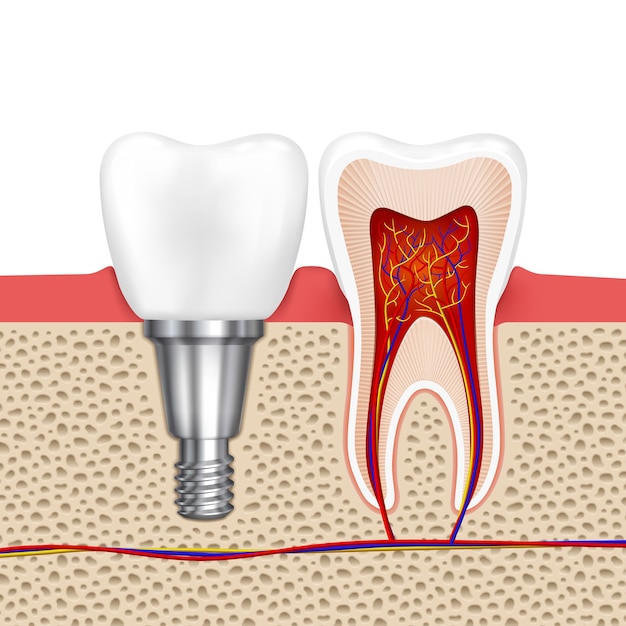 Vecteur gratuit dents saines et implant dentaire. dent d'implant, dentisterie médicale dent de santé, illustration vectorielle