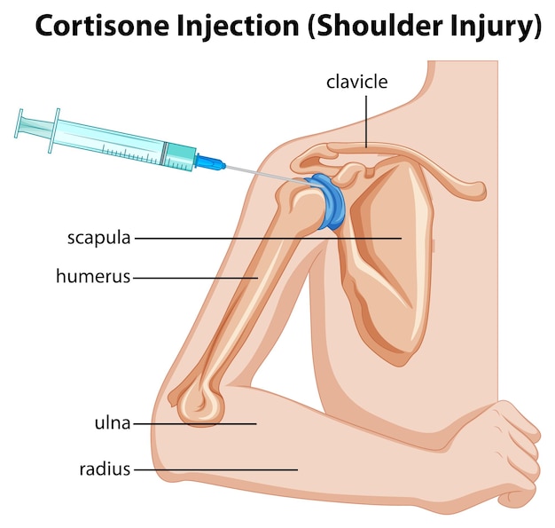 Vecteur gratuit diagramme de blessure à l'épaule par injection de cortisone