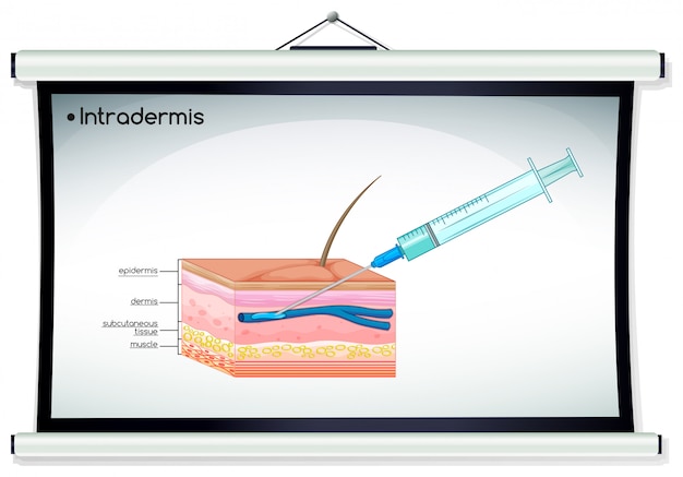 Vecteur gratuit diagramme illustrant l'injection intradermique