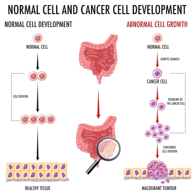 Vecteur gratuit diagramme montrant les cellules normales et cancéreuses chez l'homme