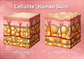 Vecteur gratuit diagramme montrant la cellulite dans la peau humaine