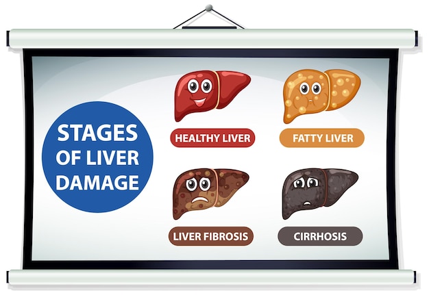 Vecteur gratuit diagramme montrant les étapes des dommages au foie