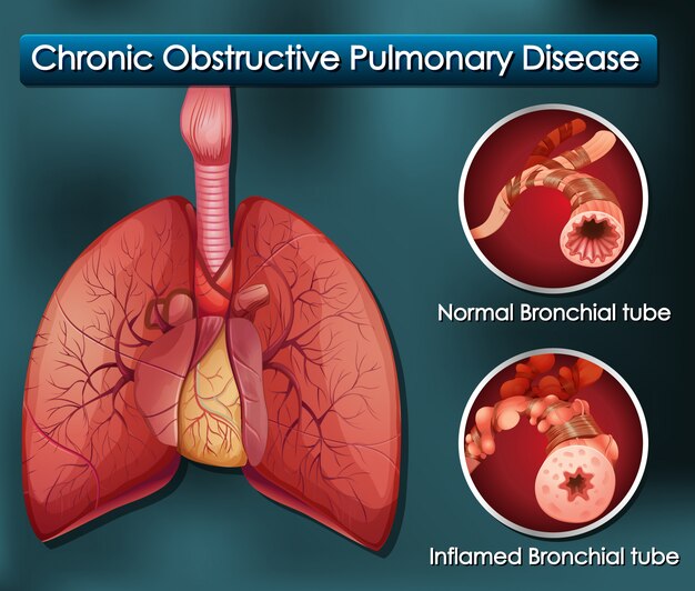 Diagramme montrant une maladie pulmonaire obstructive chronique