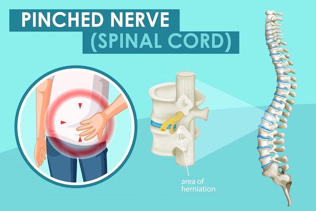 Vecteur gratuit diagramme montrant le nerf pincé chez l'homme