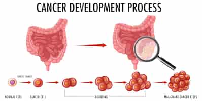 Vecteur gratuit diagramme montrant le processus de développement du cancer