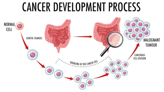 Vecteur gratuit diagramme montrant le processus de développement du cancer