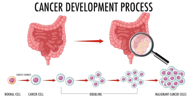 Diagramme Montrant Le Processus De Développement Du Cancer