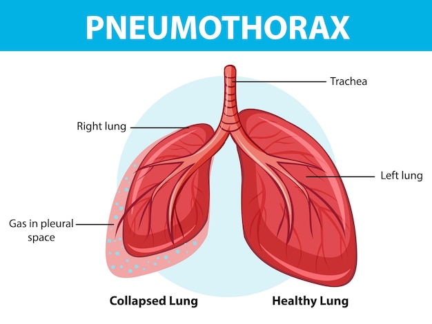 Diagramme de pneumothorax avec poumon effondré et poumon sain
