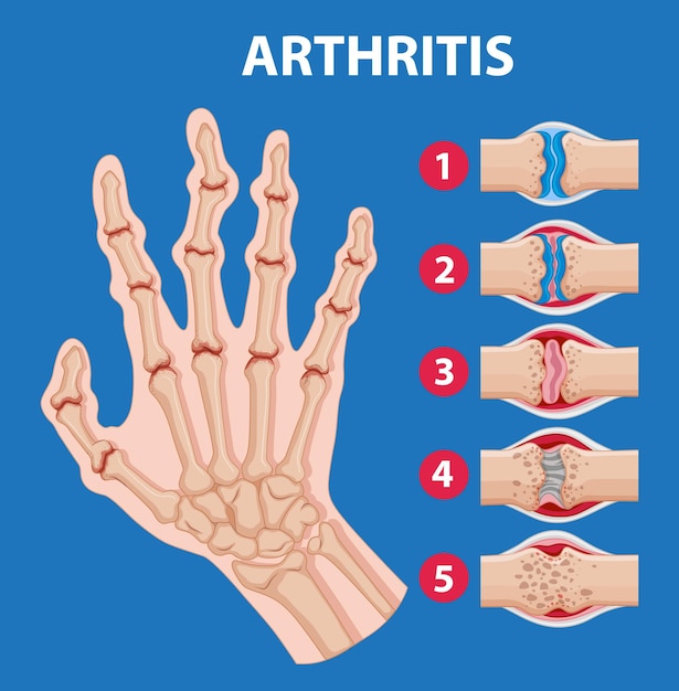 Vecteur gratuit l'enseignement de l'anatomie humaine les étapes de l'arthrite à portée de main