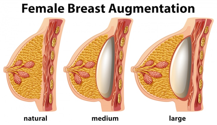 Vecteur gratuit un ensemble d&#39;augmentation mammaire féminine