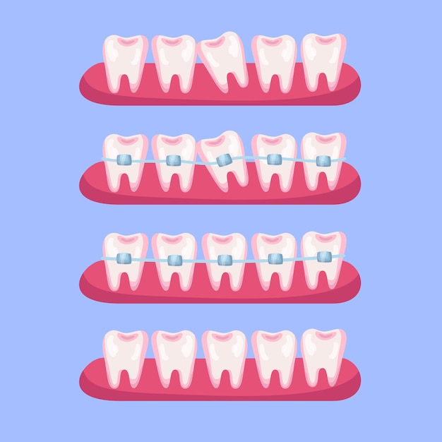 Vecteur gratuit ensemble d'illustrations de dessins animés de dents avant et après les accolades. étapes de l'alignement ou du traitement dentaire avec l'utilisation de supports pour un beau sourire. orthodontiste, soins de santé, concept de médecine