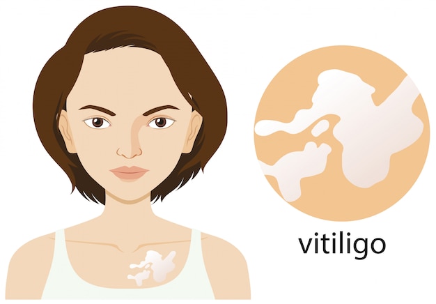 Vecteur gratuit femme atteinte de vitiligo