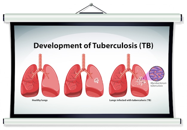 Graphique Montrant L'évolution De La Tuberculose