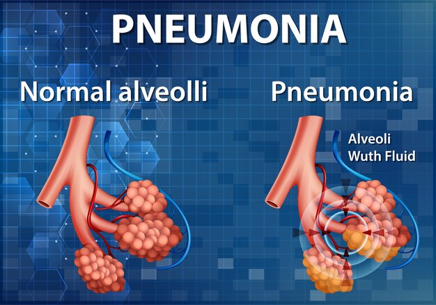 Illustration informative de la comparaison des alvéoles saines et de la pneumonie