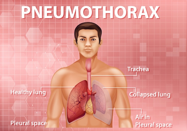 Vecteur gratuit illustration informative du pneumothorax