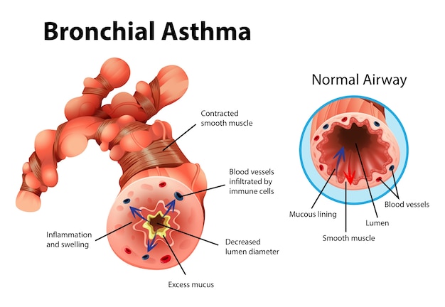 Vecteur gratuit illustration informative du tube bronchique enflammé d'asthme