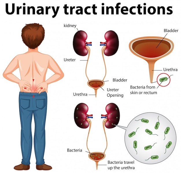 illustration-informative-des-infections-des-voies-urinaires-vecteur
