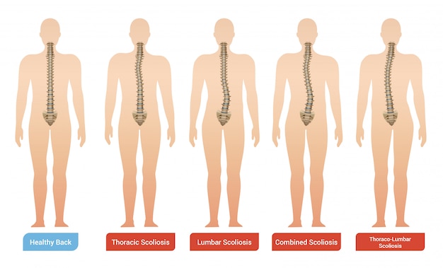 Vecteur gratuit images d'infographie médicale de scoliose de la courbure vertébrale sertie de silhouettes du corps humain avec la colonne vertébrale et le texte