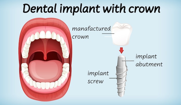 Implant dentaire avec couronne