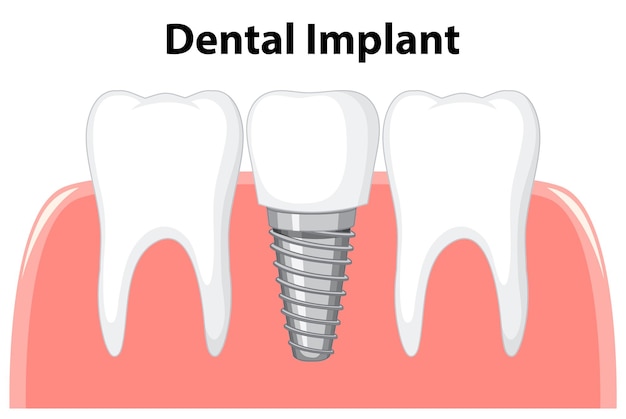 Implant dentaire en gomme sur fond blanc