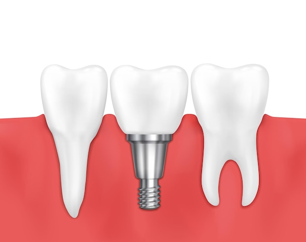 Vecteur gratuit implant dentaire et illustration de la dent normale