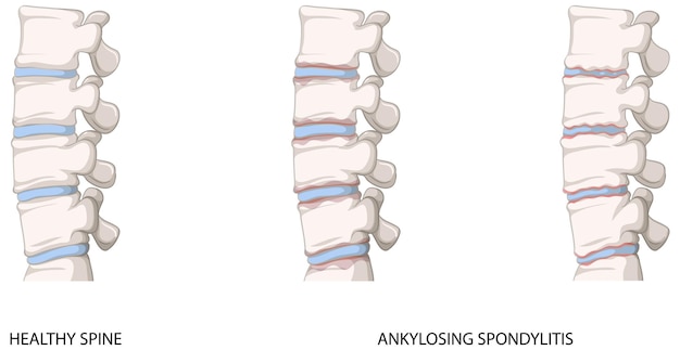 Infographie De La Colonne Vertébrale Saine Et De La Spondylarthrite Ankylosante