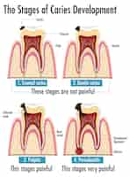 Vecteur gratuit infographie de l'homme aux stades de développement de la carie