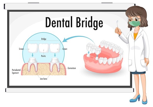 Infographie De L'homme Dans Le Bridge Dentaire Sur Fond Blanc