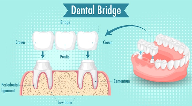 Vecteur gratuit infographie de l'humain dans le bridge dentaire