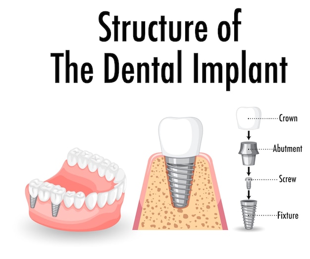 Vecteur gratuit infographie de l'humain dans la structure de l'implant dentaire