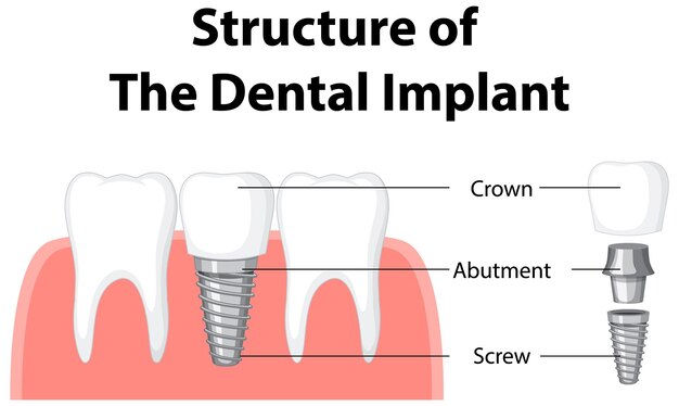 Infographie de l'humain dans la structure de l'implant dentaire