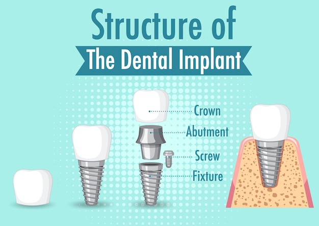 Vecteur gratuit infographie de l'humain dans la structure de l'implant dentaire