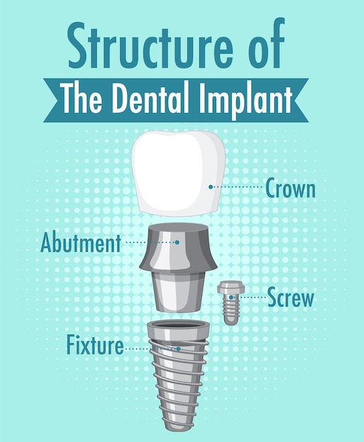 Vecteur gratuit infographie de l'humain dans la structure de l'implant dentaire