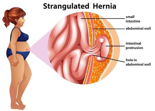 Infographie D'informations Sur La Hernie étranglée