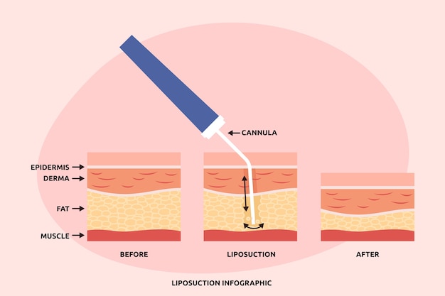 Infographie De Liposuccion Design Plat Dessiné à La Main