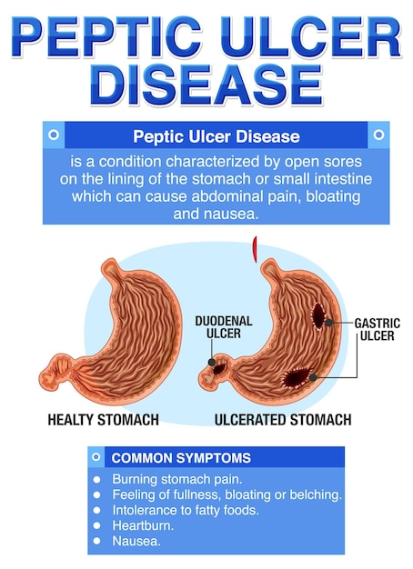 Vecteur gratuit infographie sur la maladie de l'ulcère gastro-duodénal expliquée