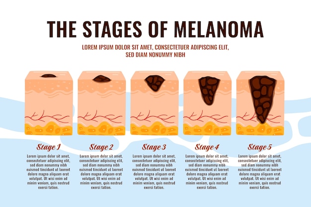 Vecteur gratuit infographie sur le mélanome design plat dessiné à la main