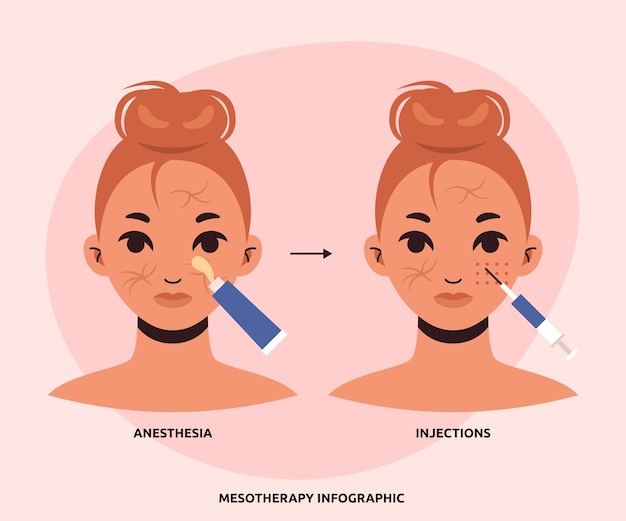 Infographie De Mésothérapie Design Plat Dessiné à La Main