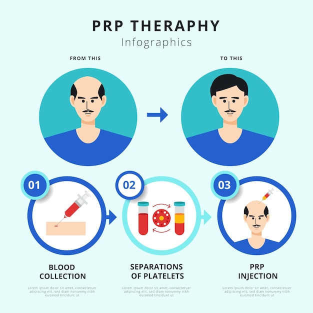 Infographie De La Procédure Prp Dessinée à La Main