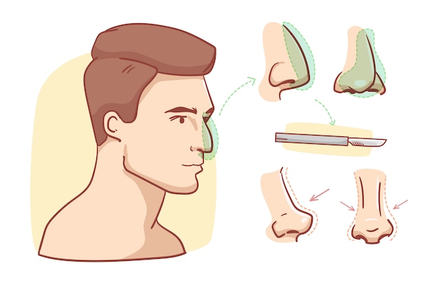 Vecteur gratuit infographie de rhinoplastie dessinée à la main