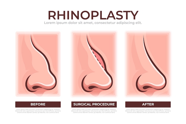 Vecteur gratuit infographie de rhinoplastie dessinée à la main