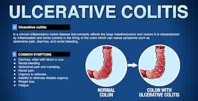Vecteur gratuit infographie sur les symptômes de la colite ulcéreuse